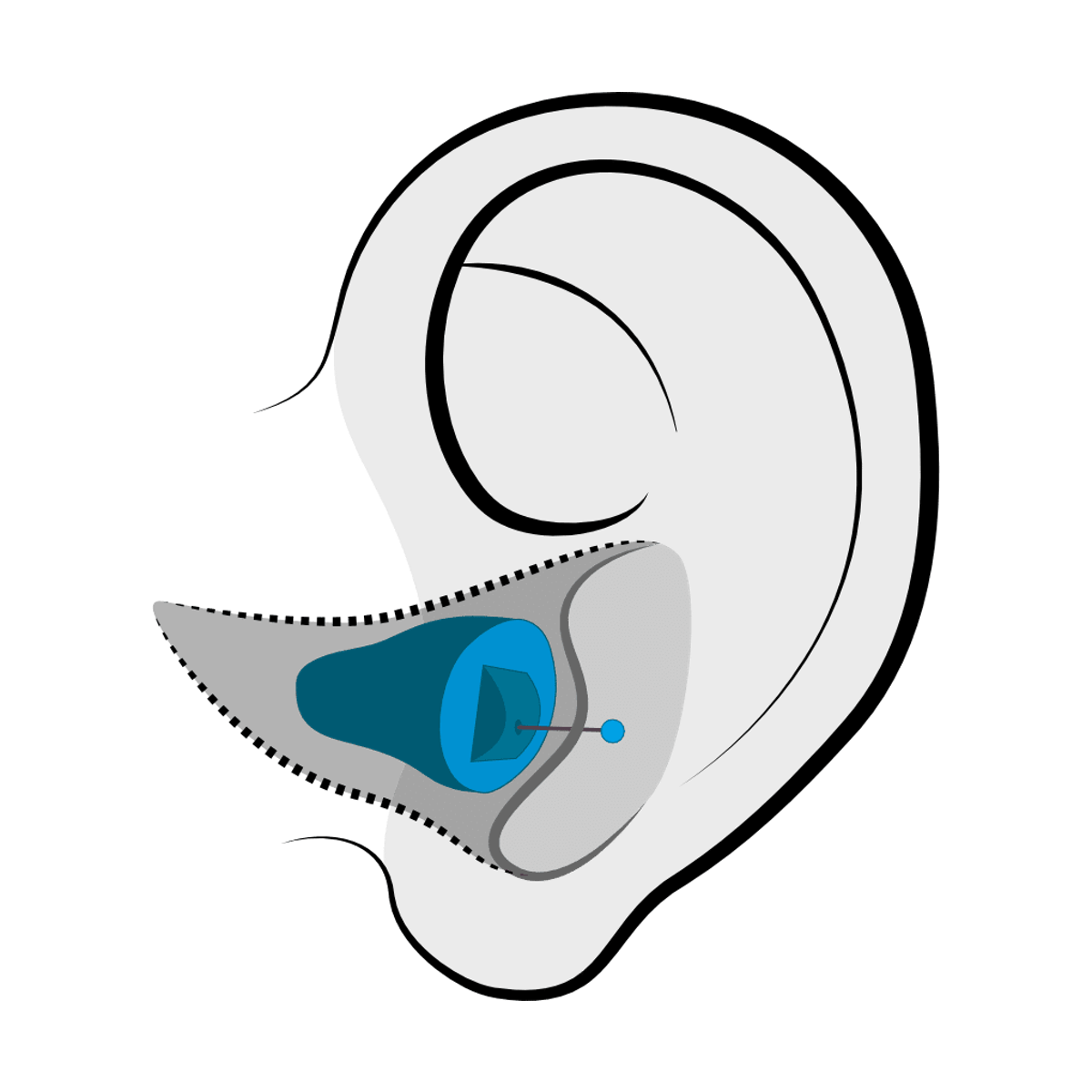 Invisible-in-Canal (IIC) hearing aid style